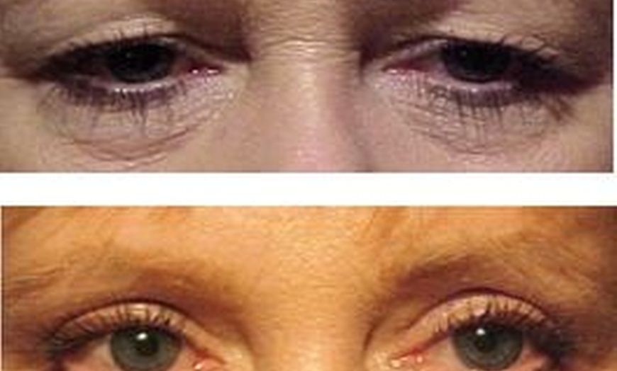 Image 2: Up to 45% Off Eyelid Surgery at Burien Medical Eye Care
