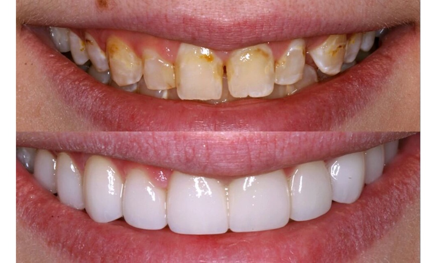 Image 2: Get a One Dental Exam, X-ray w/t Tooth cosmetic White Filling & More
