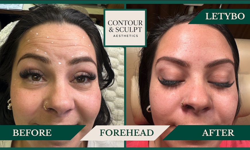 Image 8: 20-60 Units of Letybo for Frown Lines at Contour And Sculpt 