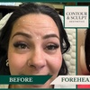 Image 8: 20-60 Units of Letybo for Frown Lines at Contour And Sculpt 