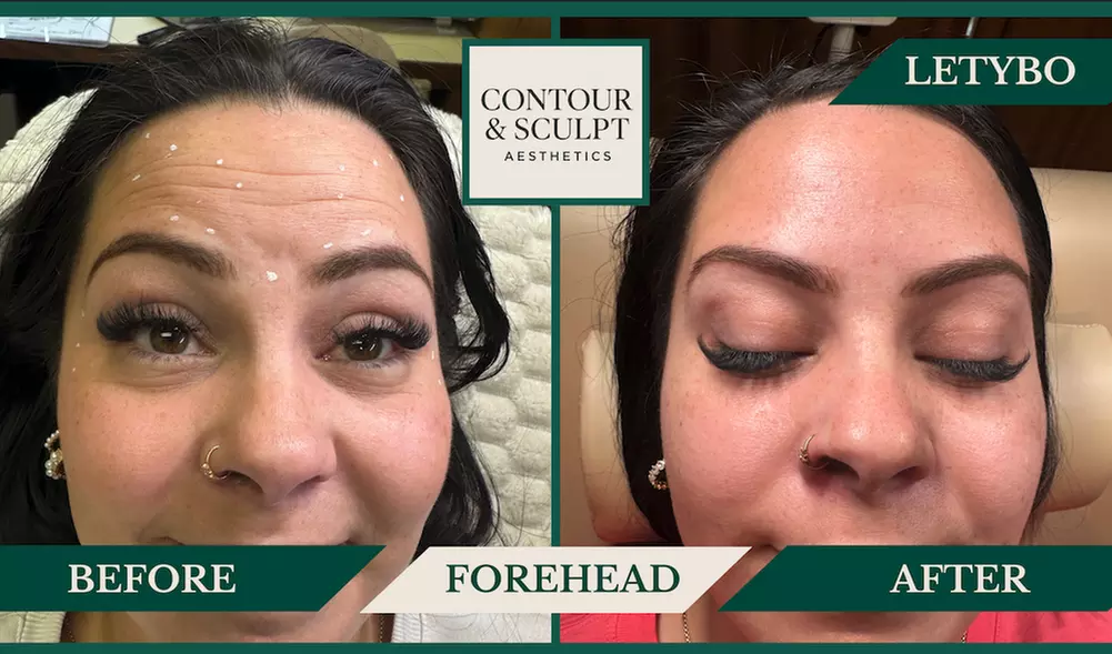 20-60 Units of Letybo for Frown Lines at Contour And Sculpt