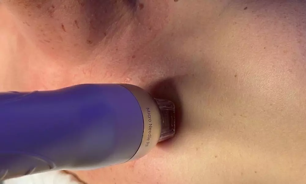 Zabiegi beauty: radiofrekwencja mikroigłowa, elektrostymulacja i inne