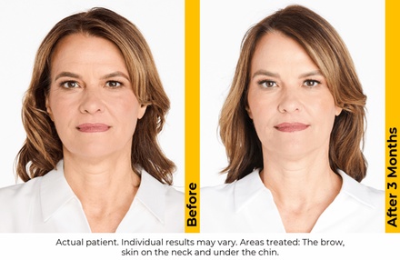 Ultherapy Prime Brow Lift - O2 Aesthetics