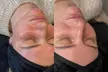 Mikrodermabrazja z maską lub mezoterapia bezigłowa - Image 3