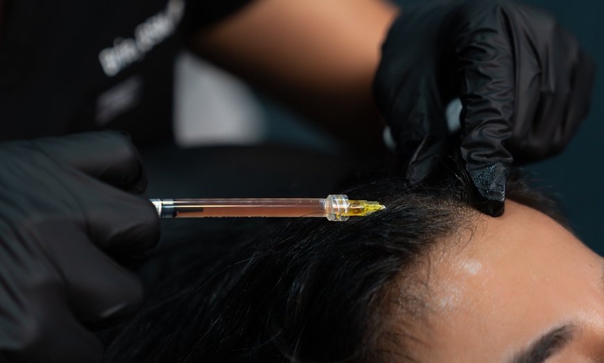 Image 8: PRP Hair Restoration for Full Head, Crown, or Hairline 