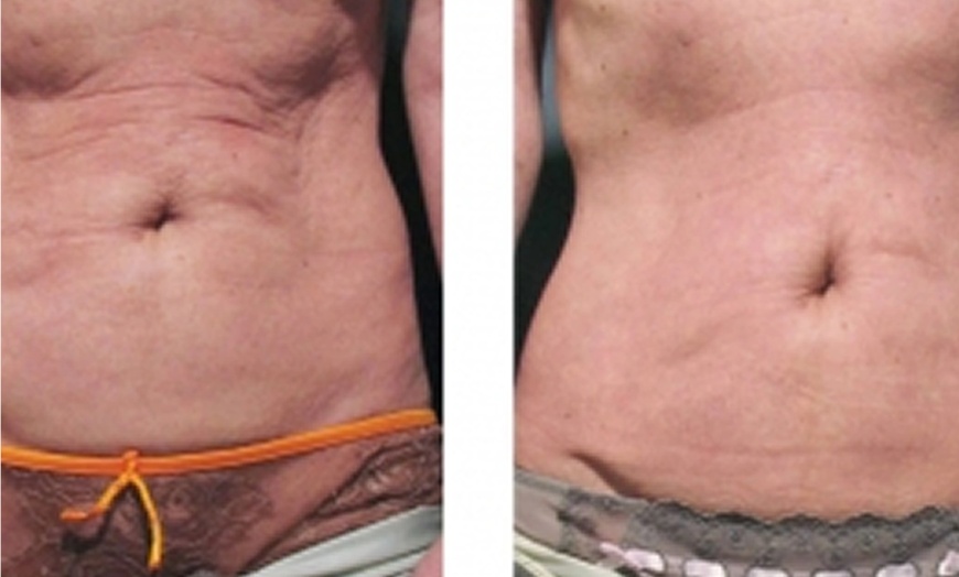 Image 3: One or Two Cavi-Lipo Fat Loss Treatments