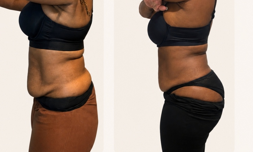 Image 3: Emerald Laser Total Body Fat Loss at Your Sculpt Studio DC