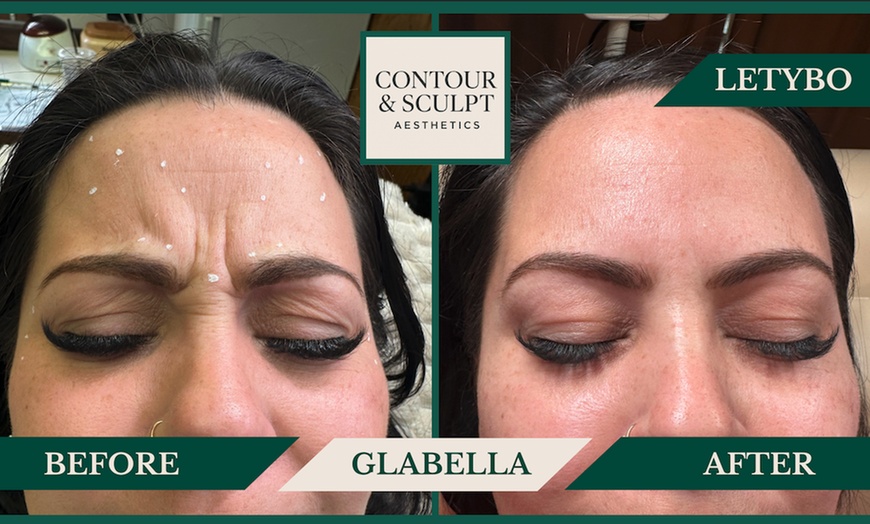 Image 9: 20-60 Units of Letybo for Frown Lines at Contour And Sculpt 
