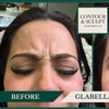 Image 9: 20-60 Units of Letybo for Frown Lines at Contour And Sculpt 