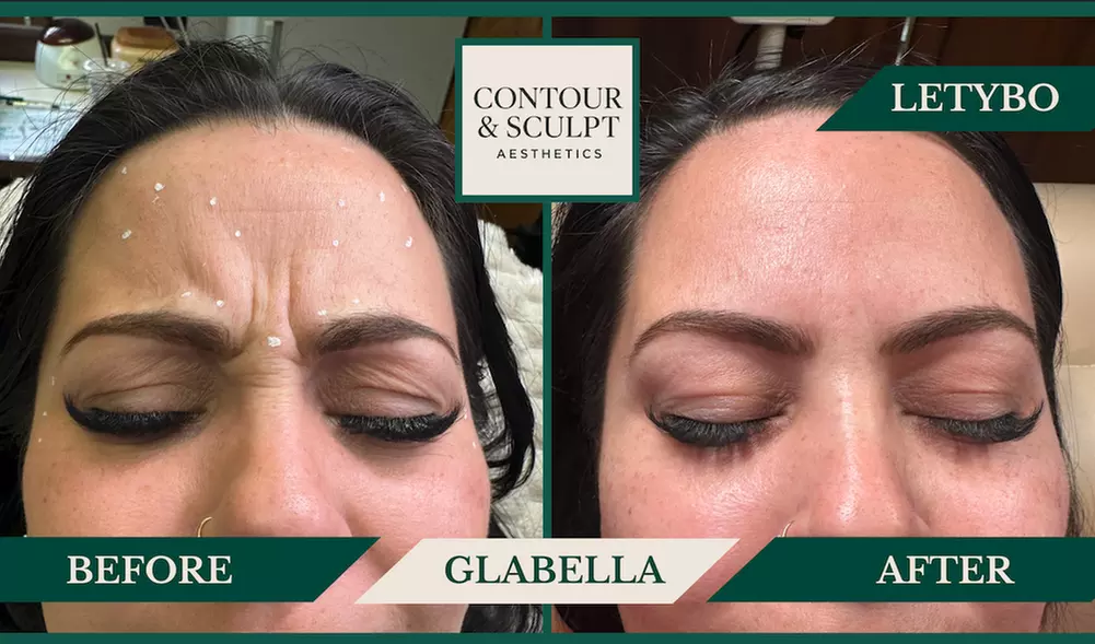 20-60 Units of Letybo for Frown Lines at Contour And Sculpt