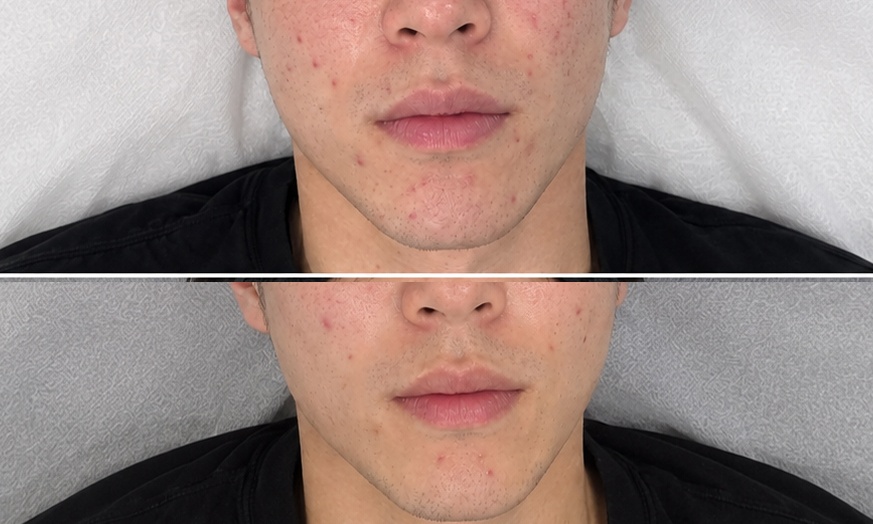 Image 3: 1 or 3 IPL Acne, Melasma, Brown Spots, or Rejuvenation Treatments
