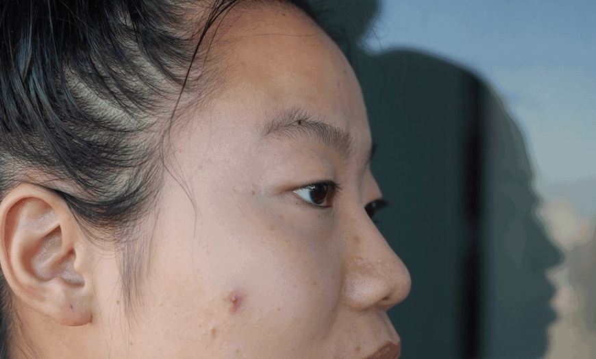 Image 2: Consultation + Cold Sore & Genital Herpes Prevention - Valacyclovir