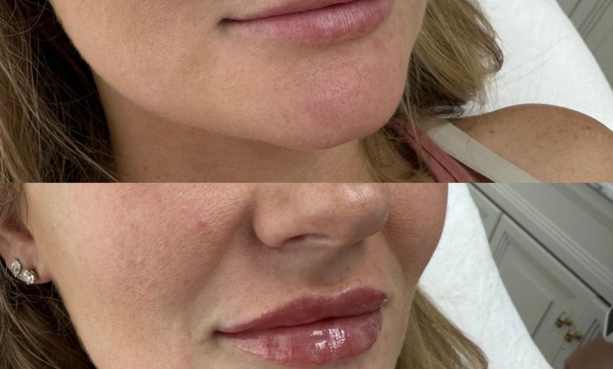 Image 9: Dermal Filler & Botulinum Toxin Treatments for Facial Rejuvenation