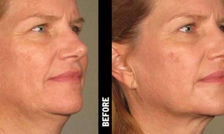 Image 3: Ultherapy: Non-Invasive Skin Lifting & Tightening for Face & Neck