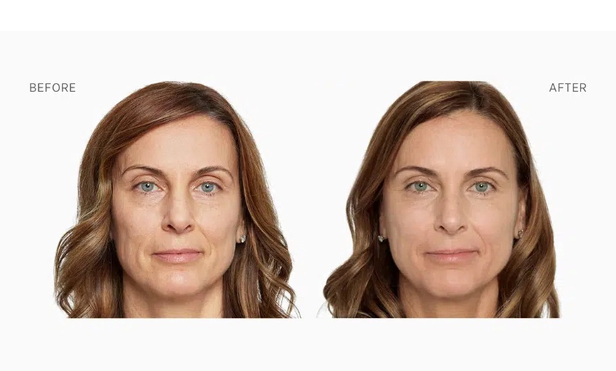 Image 4: Sculptra Injection for Natural Looking Results