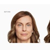 Image 4: Sculptra Injection for Natural Looking Results