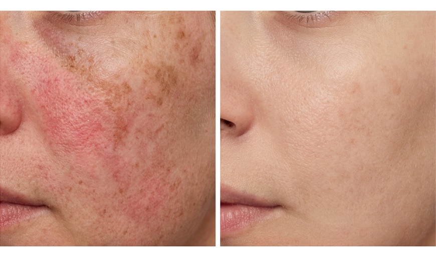 Image 2: Prescription Skin Treatments for Redness and Dark Spots