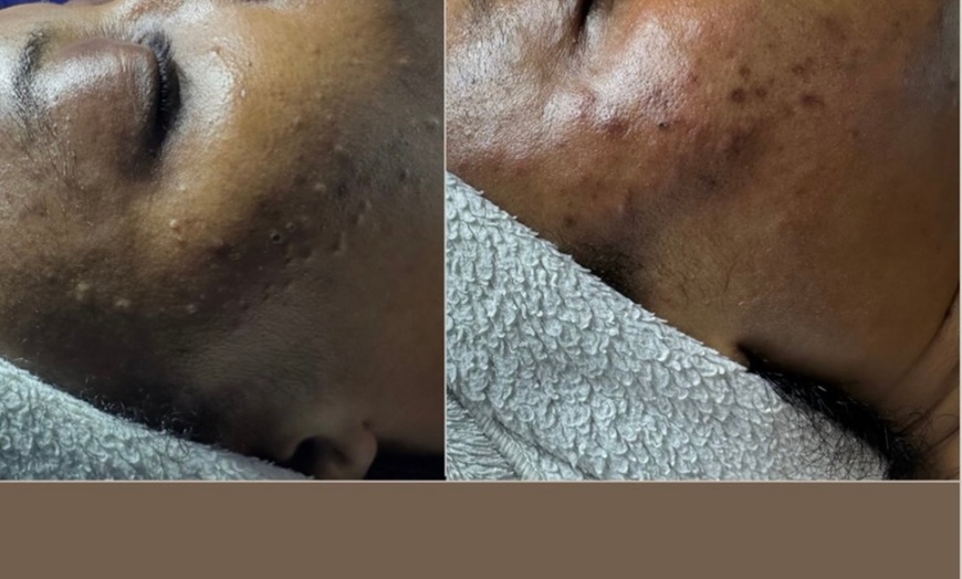 Image 2: Signature Facials & Acne Skincare Treatments | Belle’s Suite