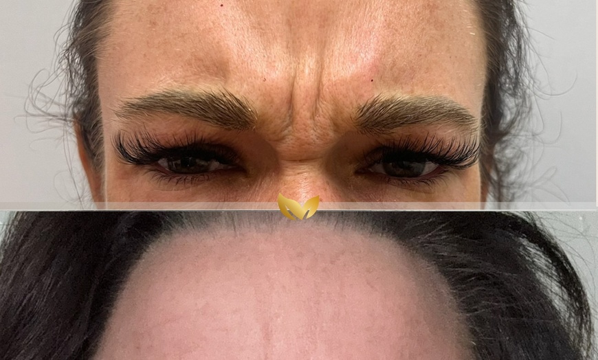 Image 11: Dermal Filler & Botulinum Toxin Treatments for Facial Rejuvenation