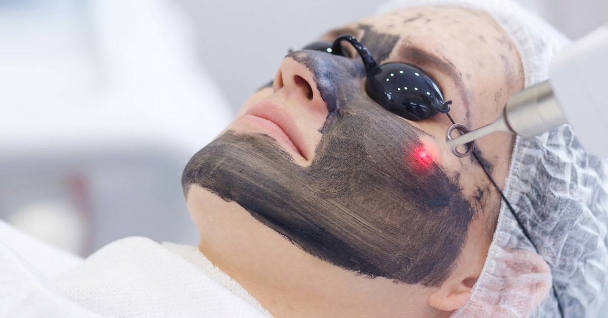 Laserowy peeling węglowy na twarz – 1, 2 lub 3 zabiegi