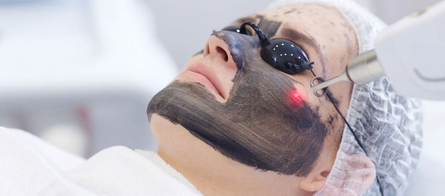 Laserowy peeling węglowy na twarz – 1, 2 lub 3 zabiegi