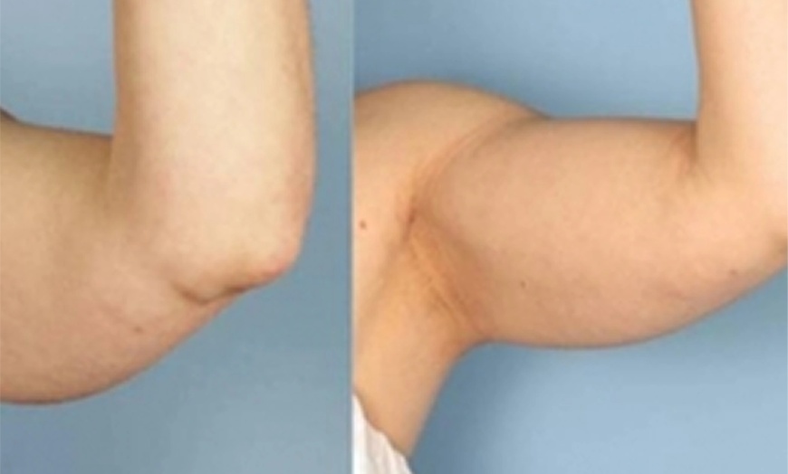 Image 4: One or Two Cavi-Lipo Fat Loss Treatments