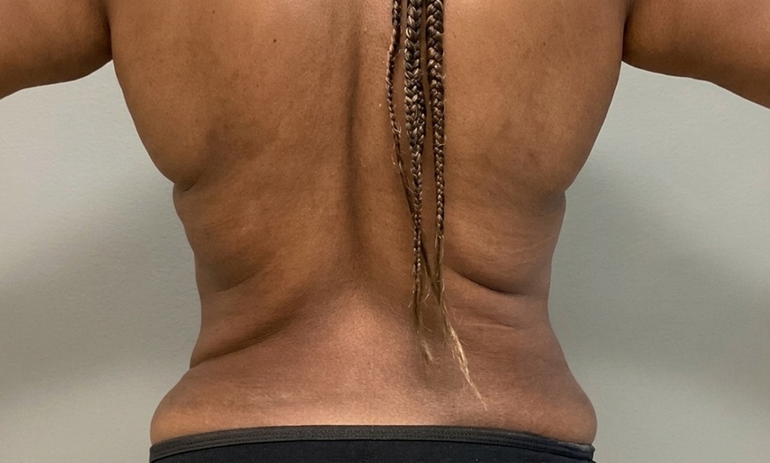 Image 3: 64% Off Total Body Contouring with Lymphatic Drainage Massage