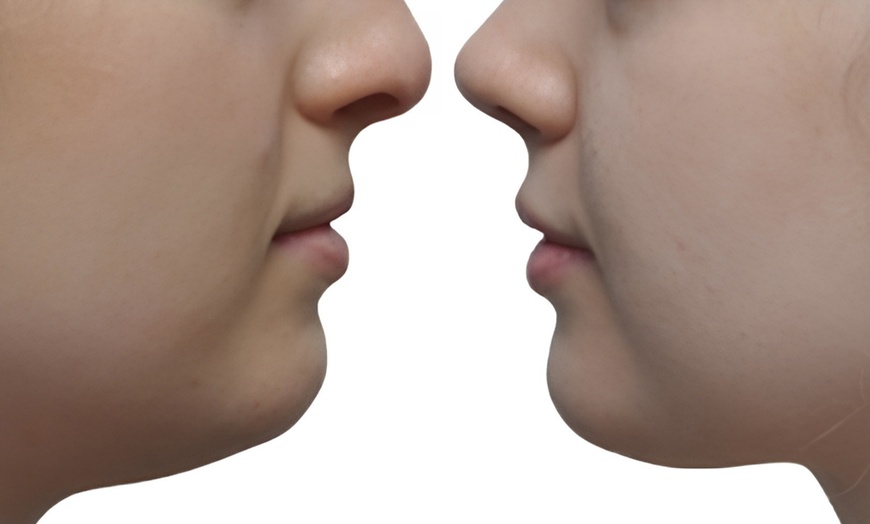 Image 6: Up to 55% Off on Chin Sculpt & Chin Sculpt Max