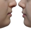 Image 6: Up to 55% Off on Chin Sculpt & Chin Sculpt Max