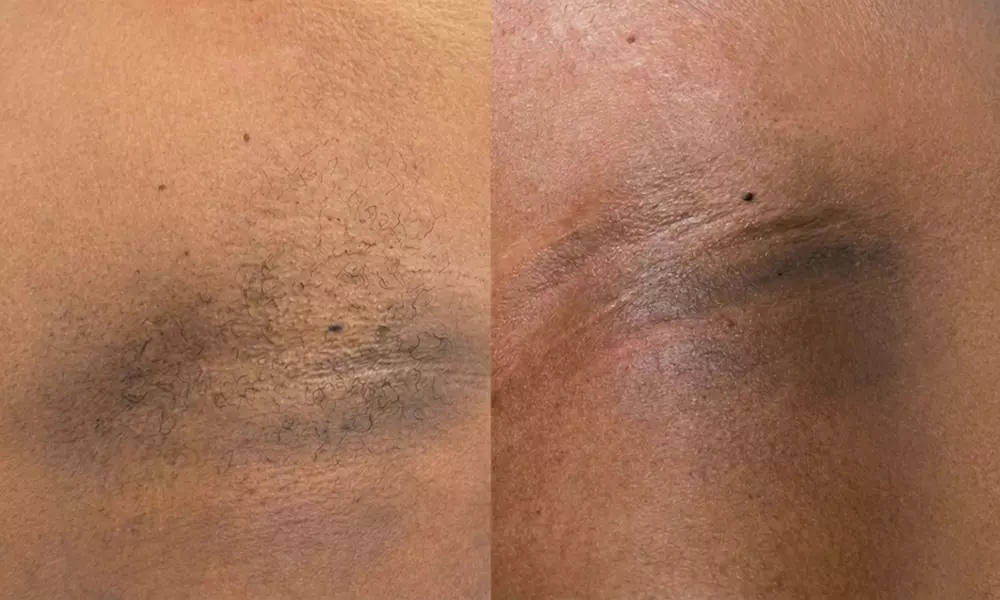 Wax Packages: One, Two. or Three Brazilian Wax or One Full Body Waxing