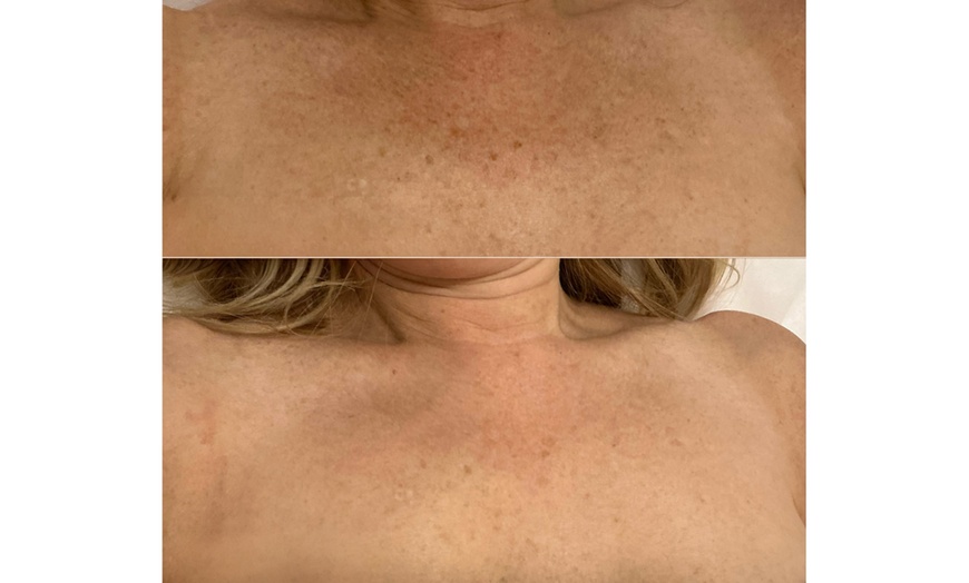 Image 2: 1 or 3 IPL Acne, Melasma, Brown Spots, or Rejuvenation Treatments
