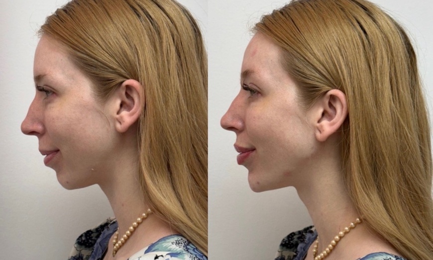 Image 6: Dermal Filler & Botulinum Toxin Treatments for Facial Rejuvenation