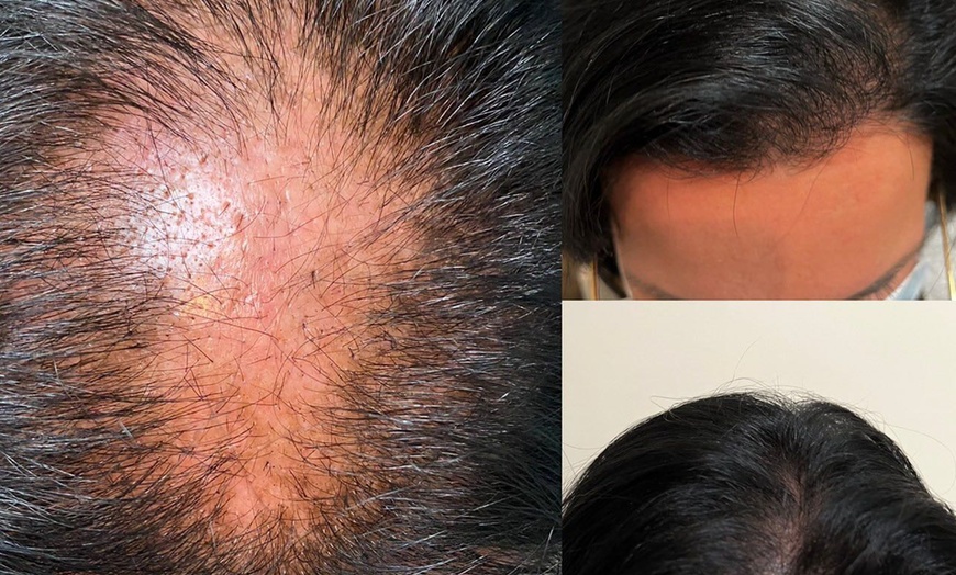 Image 5: Revitalize your Skin or Hair with Choice of PRP Treatments