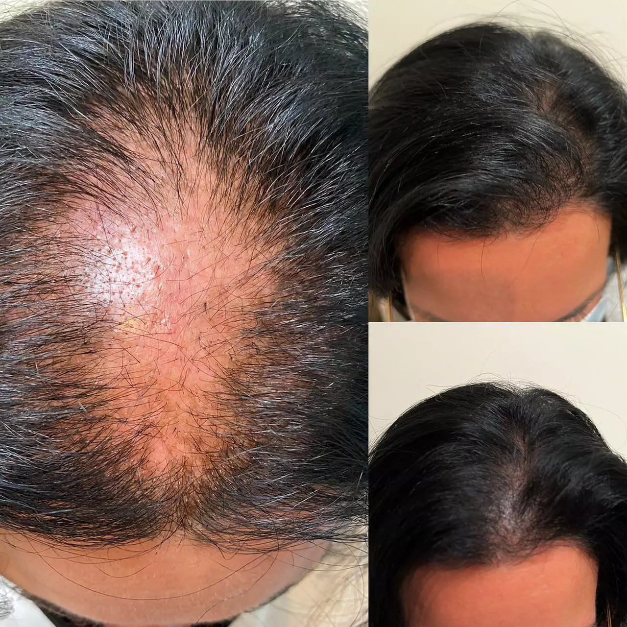 Revitalize your Skin or Hair with Choice of PRP Treatments