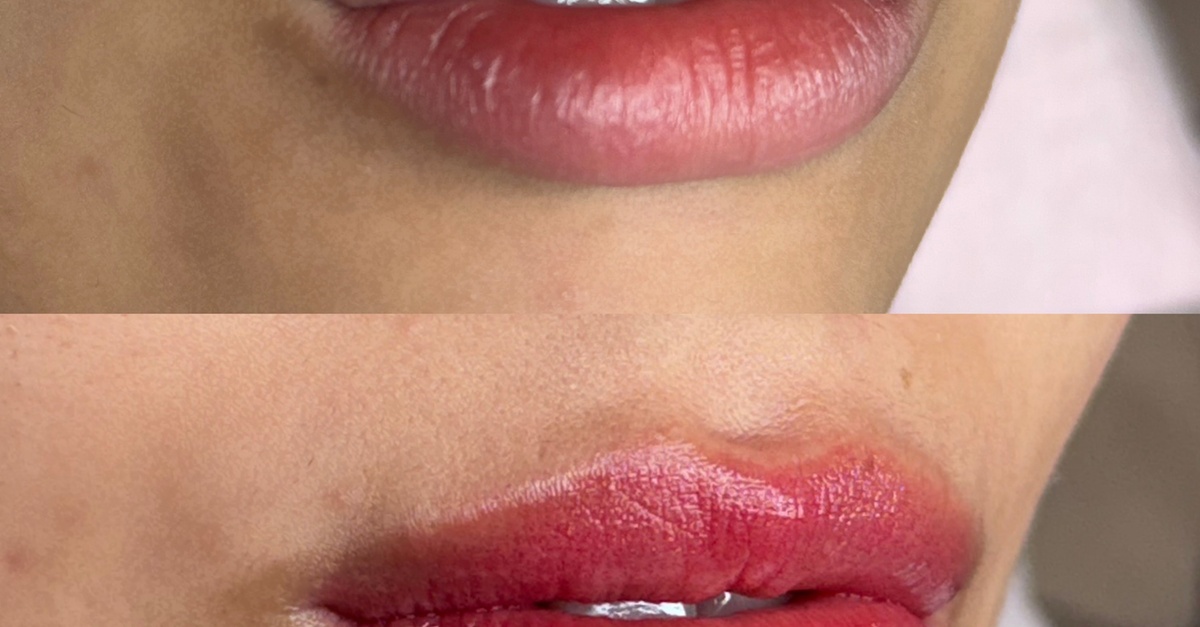 Sesiones de hidratación de labios con Dermapen en Barcelona