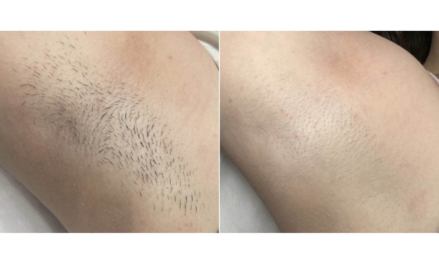 Image 4: 8 Sessions Laser Hair Removal for Various Areas at Lotus Health & Aesthetics: Red Bank