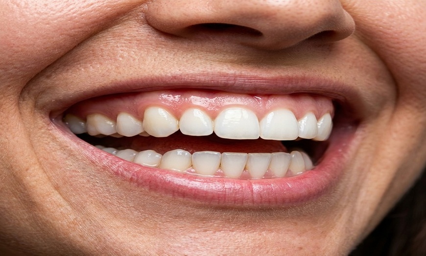 Image 8: Brighten Your Smile: Touch Up or Full-Service Teeth Whitening Session