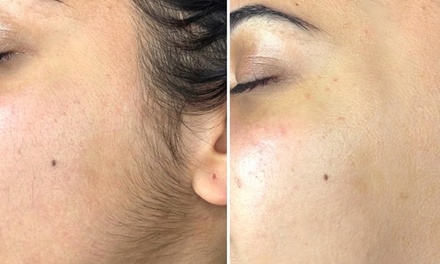 One Microdermabrasion Treatment - ILLUME Skin Spa