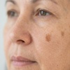 Image 3: Advanced Skin Imperfection Removal with One to Ten Treatments!
