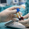 Image 1: Up to 80% Off Platelet Rich Plasma PRP Facials