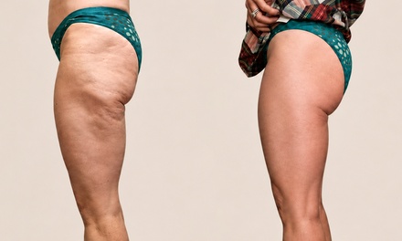 Cellulite Reduction - Thighs - Your Sculpt Studio