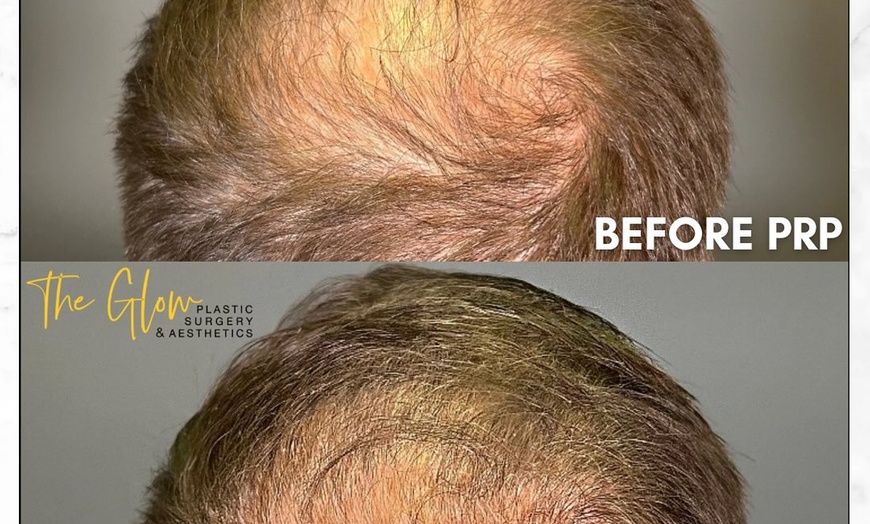 Image 3: Revitalize your Skin or Hair with Choice of PRP Treatments