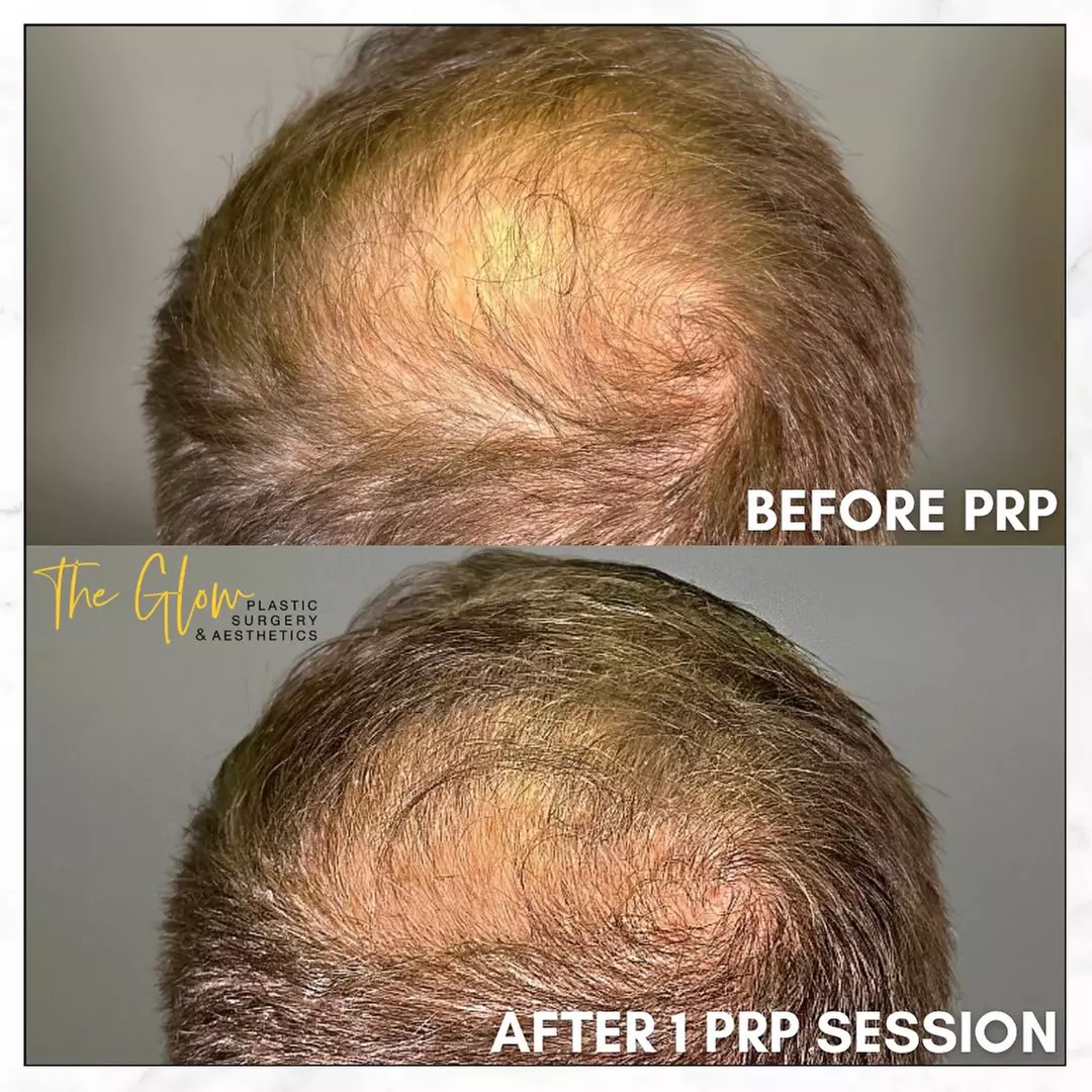 Revitalize your Skin or Hair with Choice of PRP Treatments