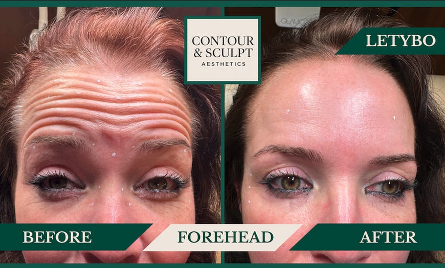 Image 10: 20-60 Units of Letybo for Frown Lines at Contour And Sculpt 