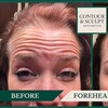Image 10: 20-60 Units of Letybo for Frown Lines at Contour And Sculpt 