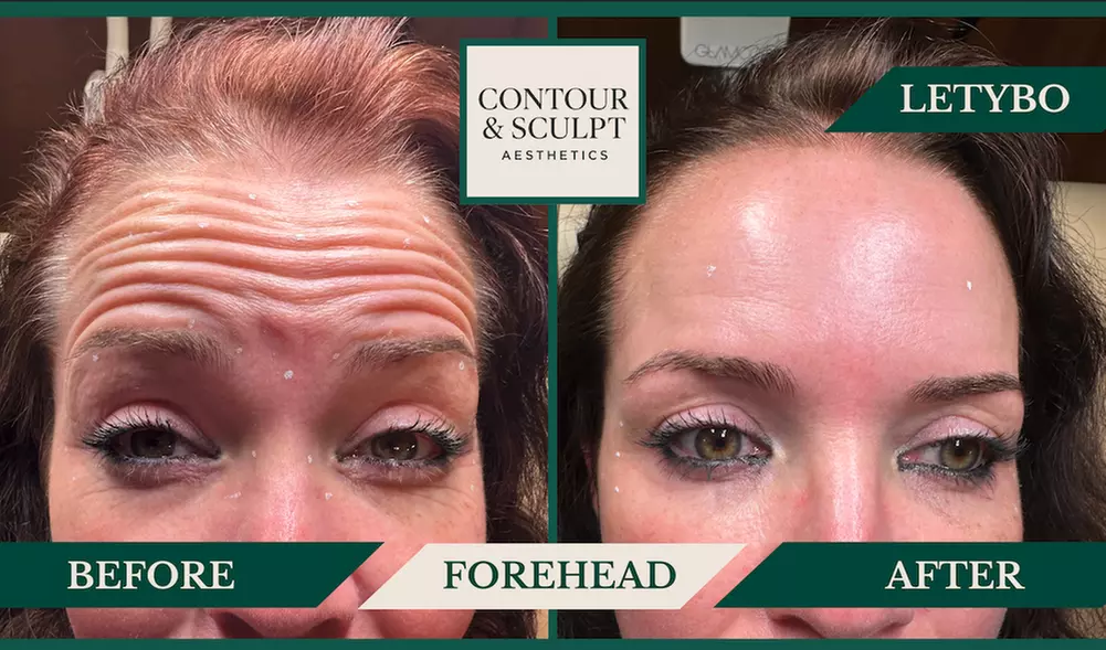 20-60 Units of Letybo for Frown Lines at Contour And Sculpt