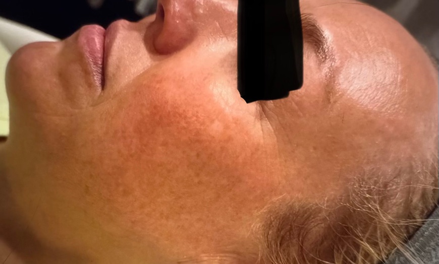 Image 3: Unleash Radiance: Transform Your Skin with a Chemical Peel Adventure!