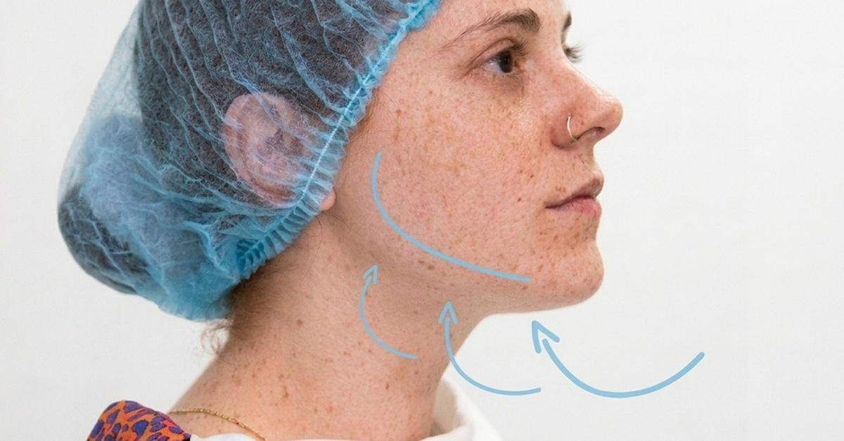Tratamiento facial HIFU 7D y maderoterapia en Madrid