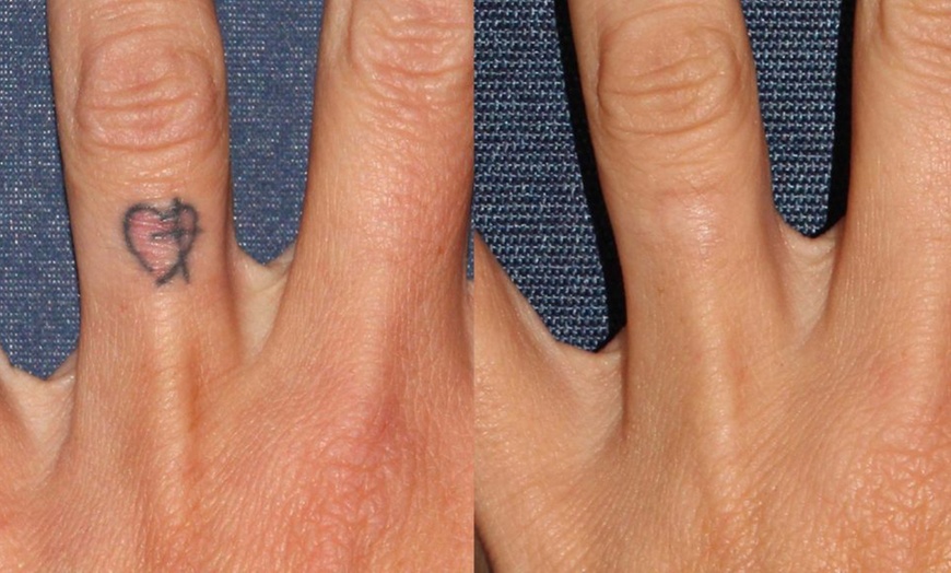 Image 2: Get 1 or 3 Laser Tattoo Removals at Sugarlime Wax and Sugaring Studio