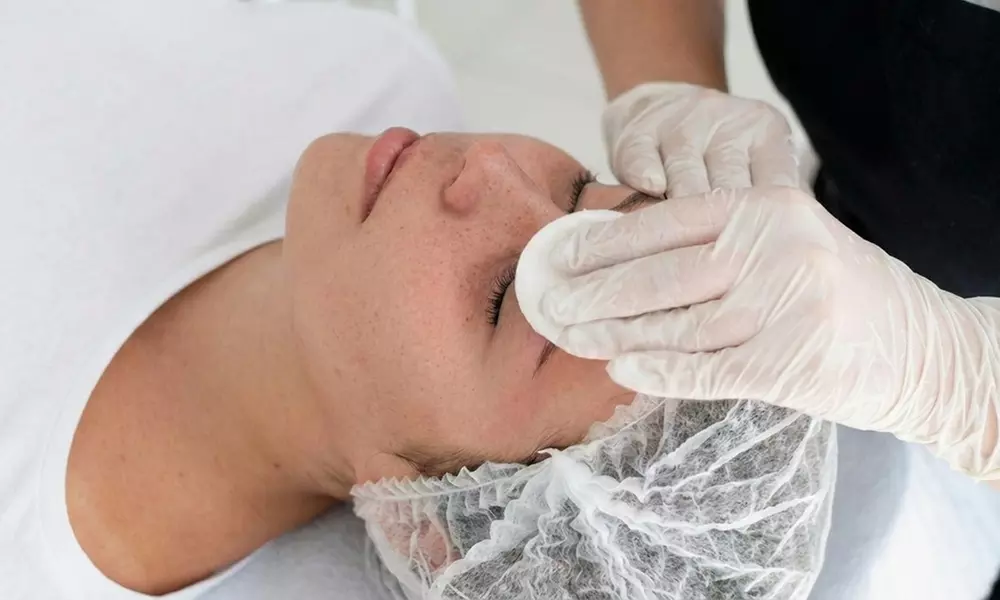 Renew Your Complexion with One or Three PCA Chemical Peels